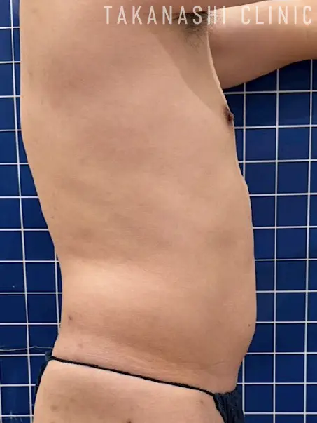 施術後（別角度1・7回）