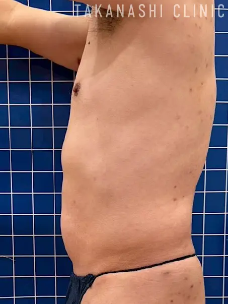 施術後（別角度2・7回）