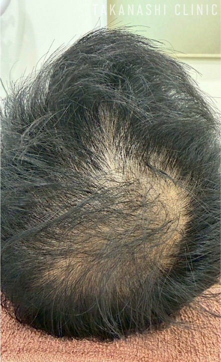 ヘアフィラー症例写真3-施術前