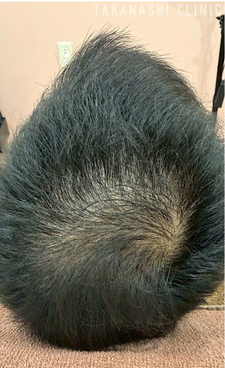 ヘアフィラー症例写真3-5回施術後