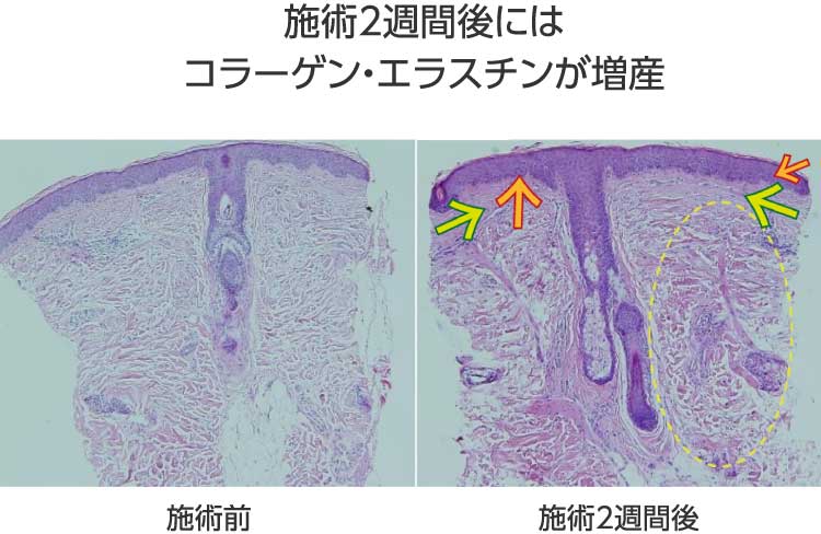 図：施術2週間後にはコラーゲン・エラスチンが増産