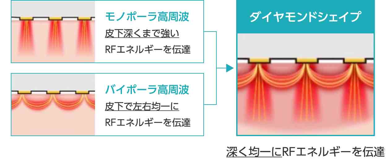 ダイヤモンドシェイプは、深く均一にRFエネルギーを伝達